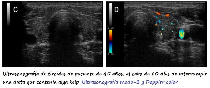 Izda: Ultrasonografía modo-B. Drcha: Doppler color